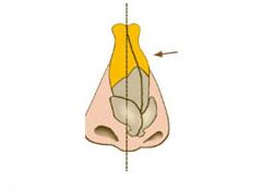歪鼻矫正