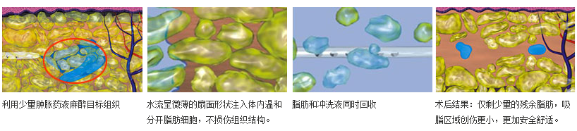 腰腹部吸脂