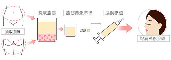 自体脂肪丰太阳穴