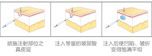 注射丰太阳穴