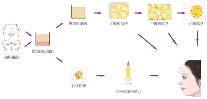 自体脂肪丰额头