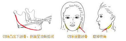下颌角整形
