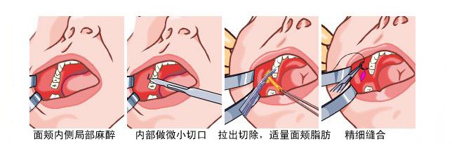 颊脂肪垫