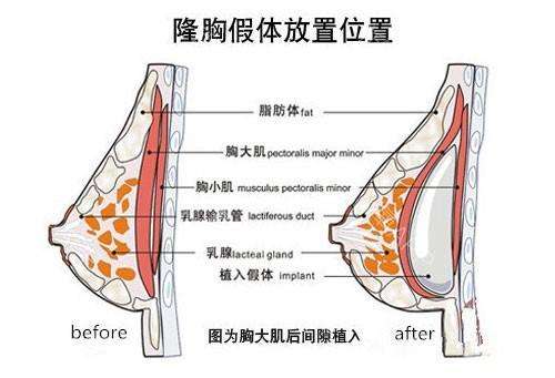 隆胸假体取出