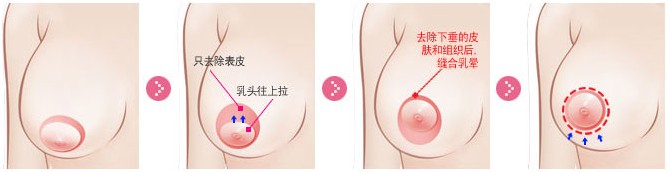 乳房下垂矫正