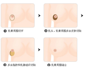 巨乳缩小