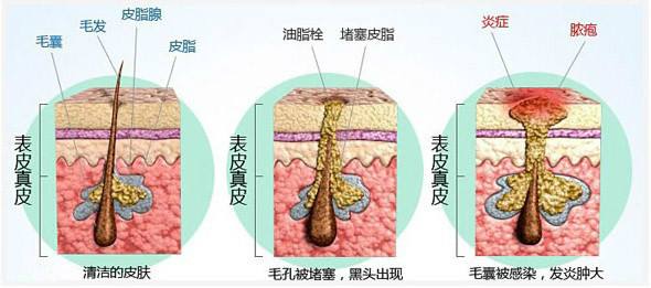 痘痘