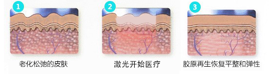 眼部除皱