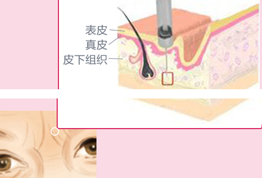 面部除皱