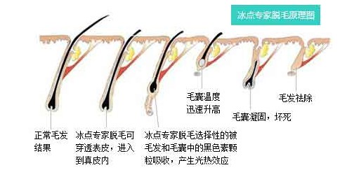 脱腋毛